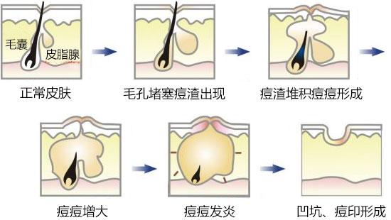 痘印的形成